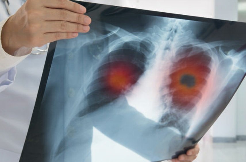 Doctor inspects a lung X-ray